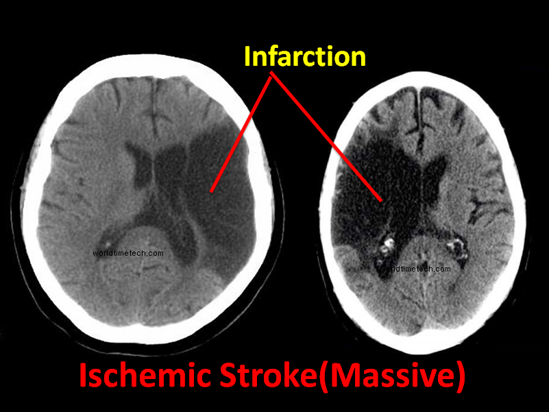 ischemic stroke massive ct scan of brain